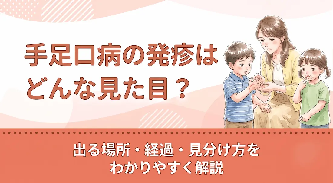手足口病の発疹はどんな見た目?出る場所・経過・見分け方をわかりやすく解説