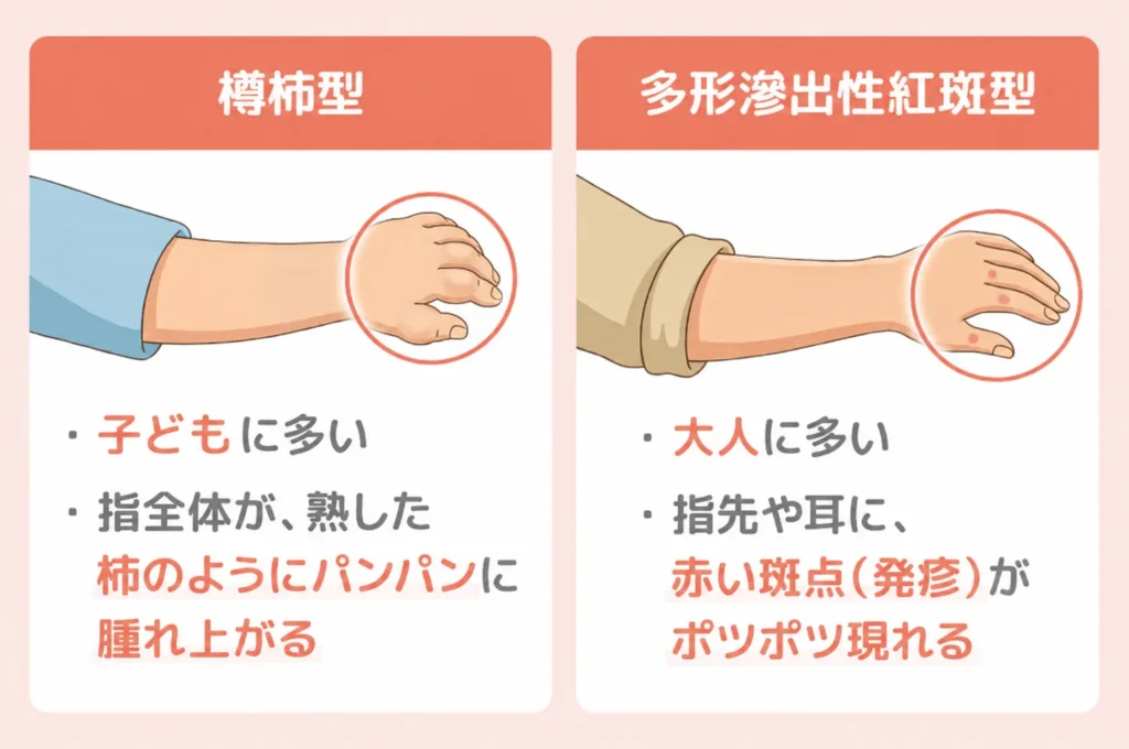 しもやけの症状とは？赤み・腫れ・痛がゆさが特徴_まとめ画像 (1)