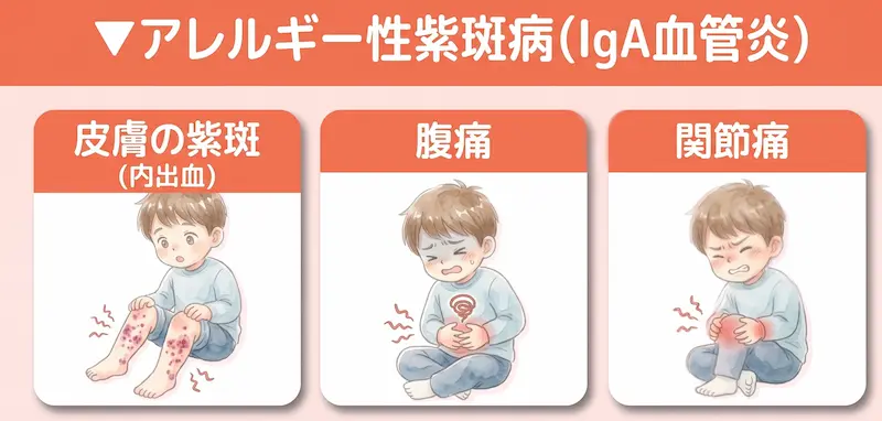 アレルギー性紫斑病（IgA血管炎）_イメージ図