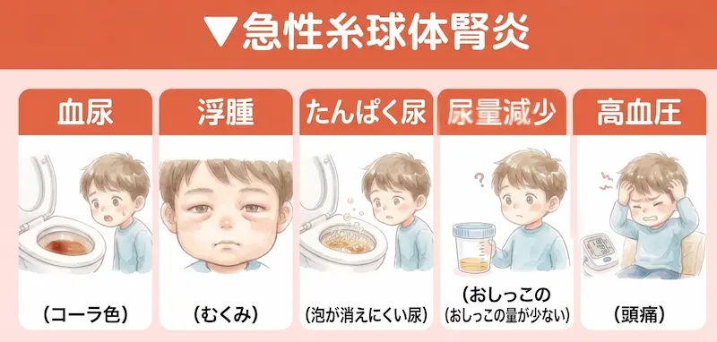 急性糸球体腎炎_イメージ図