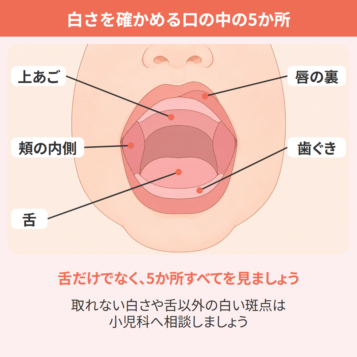 新生児の舌が白いときに確かめる場所として、舌・頬の内側・上あご・唇の裏・歯ぐきを線で示した口の中の模式図