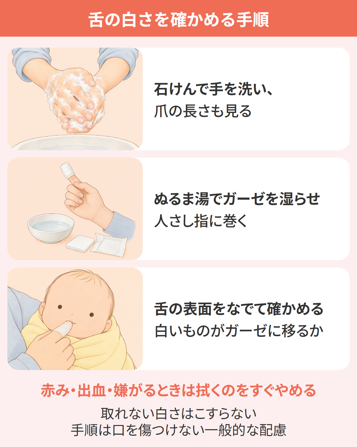 新生児の舌が白いときに、手を洗い、しめらせたガーゼを指に巻き、舌の表面をなでるように確かめる3ステップの図